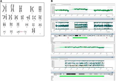 Case Report: Two cases of apparent discordance between non-invasive prenatal testing (NIPT) and amniocentesis resulting in feto-placental mosaicism of trisomy 21. Issues in diagnosis, investigation and counselling